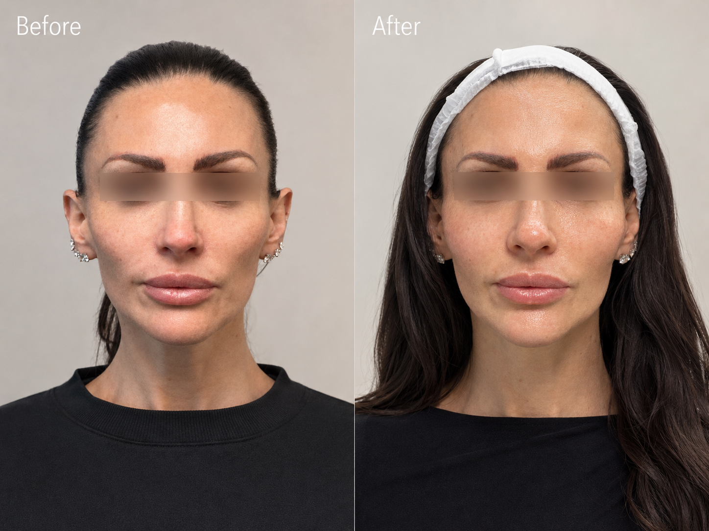 Fat transfer before and after result at Dr Vahe Clinic