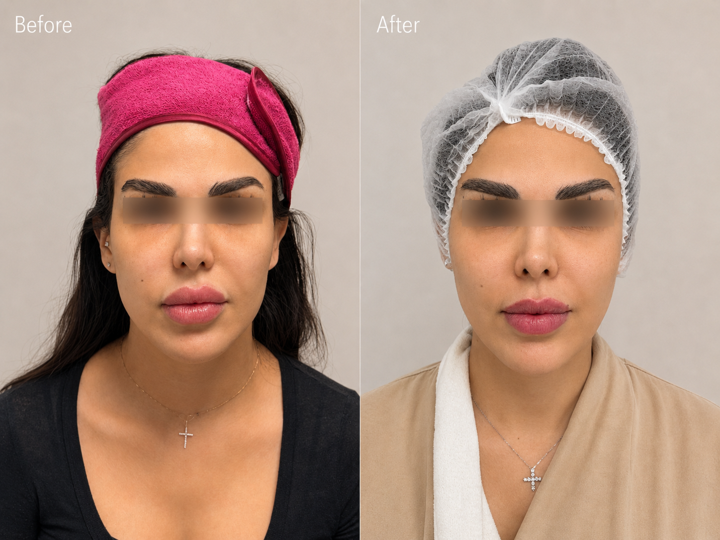 Facial fat transfer before and after result at Dr Vahe Clinic